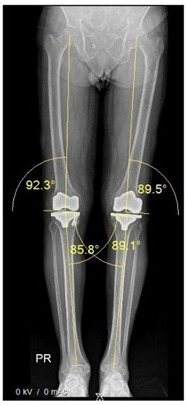  Robotic Hip Replacement - Iori 