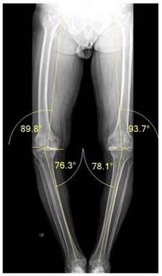 Knee Replacement - Iroi 