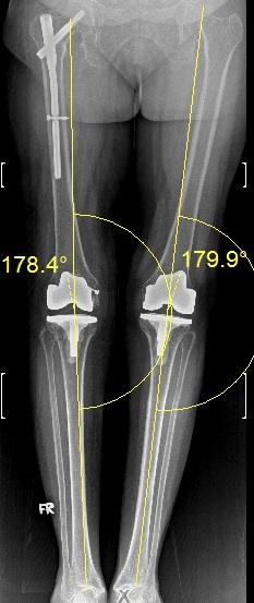 After Hip Fracture - Iori
