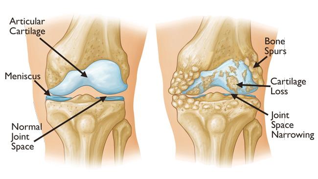 Knee Arthritis - Iori
