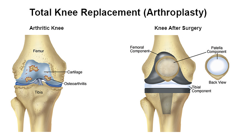 Knee Replacement - Iroi 