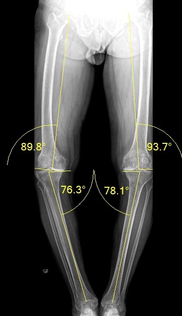 Knee Replacement - Iroi 