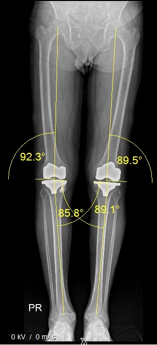  Robotic Hip Replacement - Iori 