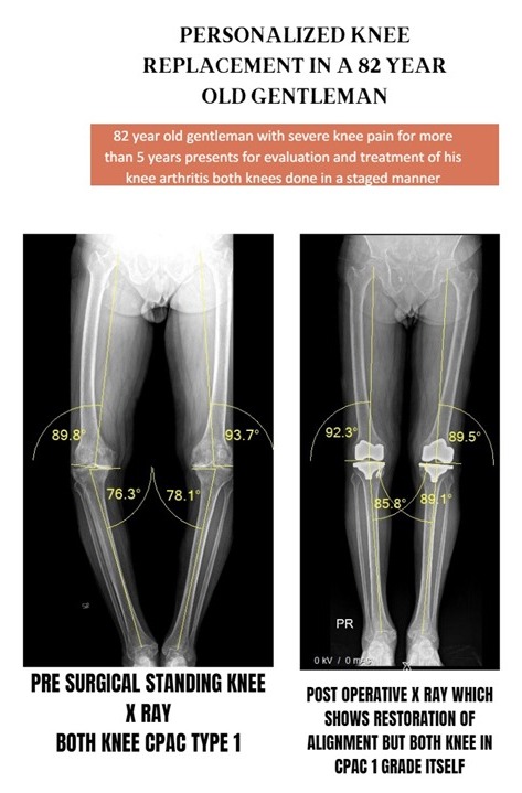 Robotic Joint Replacement - Iroi 