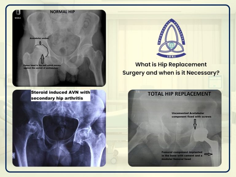 What is Hip Replacement Surgery and when is it Necessary